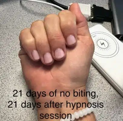 after hypnosis for nail biting