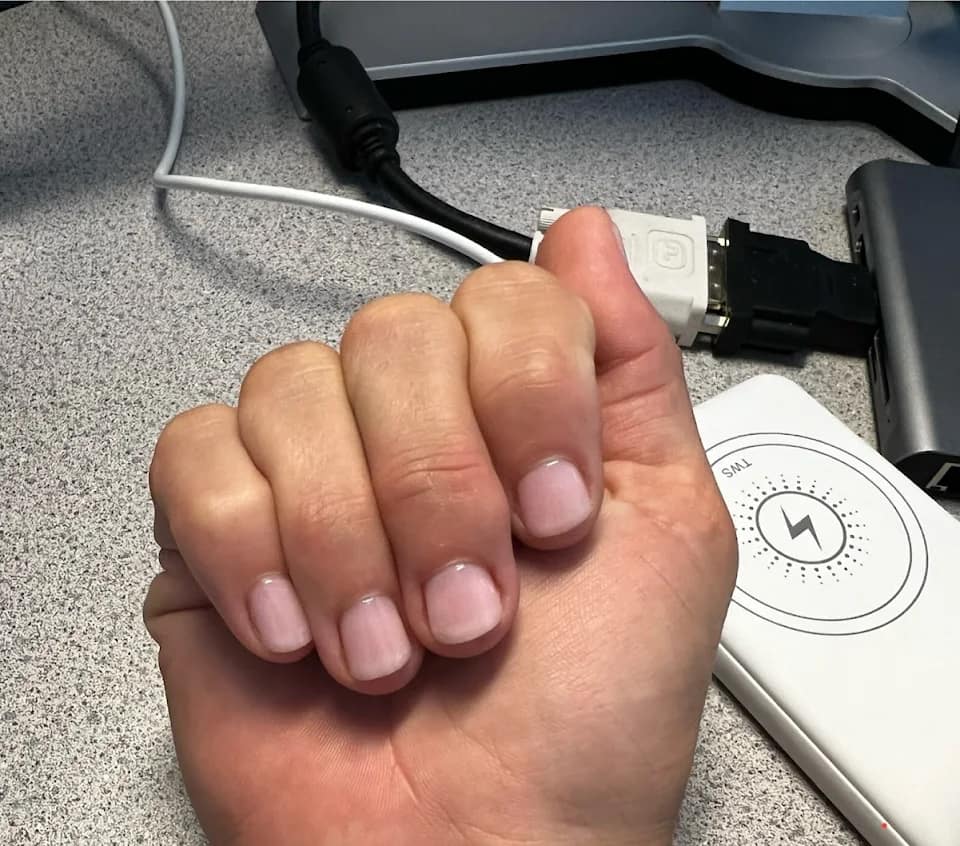 21 days after hypnotherapy